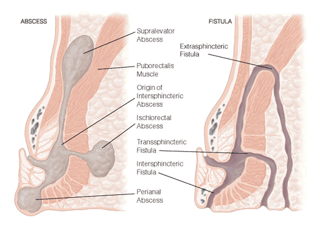 Ayurvedic Management of Fistula-in-ano