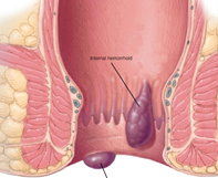 Haemorrhoids