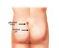 Pilonidal sinus